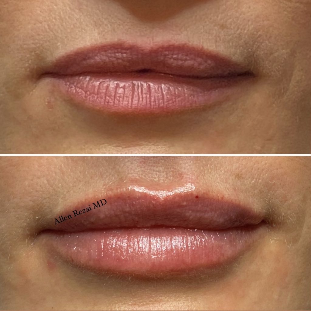 6-POINT LIP LIFT