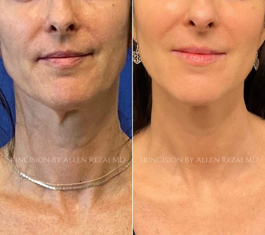 Before and 6-Months After 3rd Session of Morpheus8 Gold for the Face & Neck