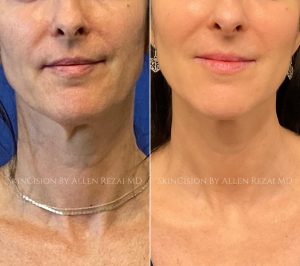 Before and 6-Months After 3rd Session of Morpheus8 Gold for the Face & Neck