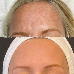 Before and After 2 Sessions of Lumecca