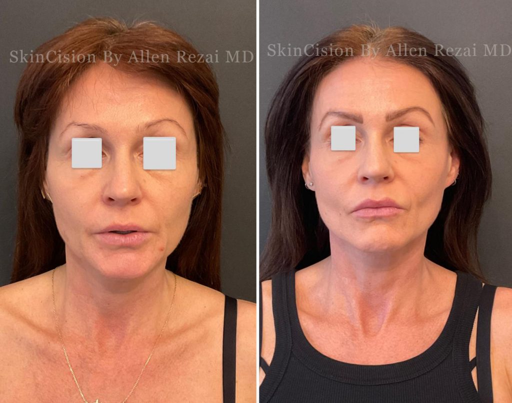 Before and 6-Months After 3rd Session of Morpheus8 Gold for the Face & Neck