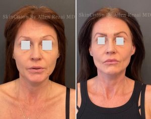 Before and 6-Months After 3rd Session of Morpheus8 Gold for the Face & Neck