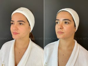 Before & Immediately After Hydrafacial