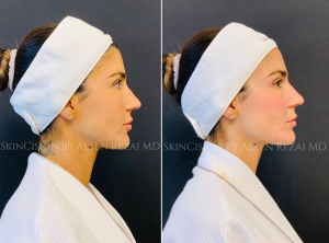 Before & Immediately After Bespoke Facial