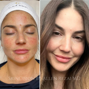 Lumecca Before and After