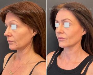 Before and 6-Months After 3rd Session of Morpheus8 Gold for the Face & Neck
