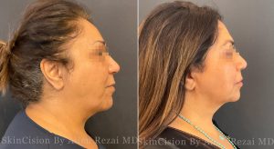 Before and 6 Weeks After FaceTite of the Mid- and Lower Face & Neck + Morpheus8 Gold