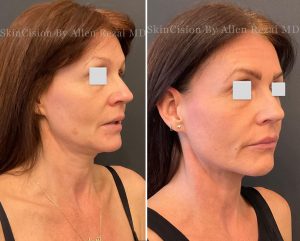 Before and 6-Months After 3rd Session of Morpheus8 Gold for the Face & Neck