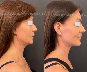 Before and 6-Months After 3rd Session of Morpheus8 Gold for the Face & Neck